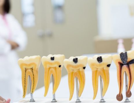 Signs You Might Need a Root Canal Treatment