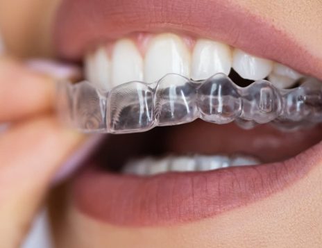 The Modern Way to Straighten Teeth Without Metal Braces in Beckenham