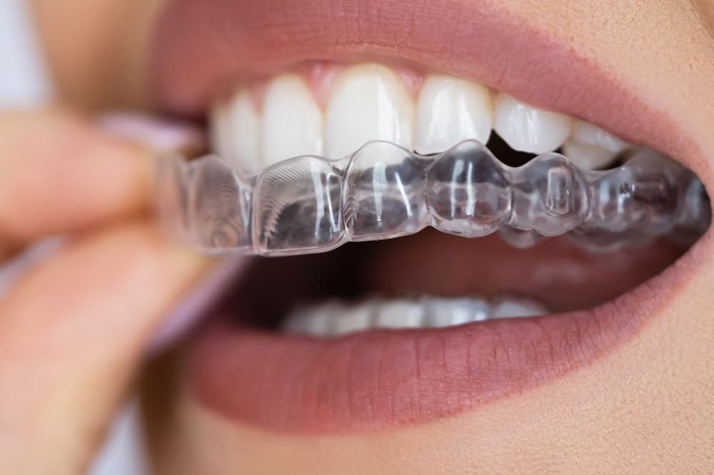 invisalign cost