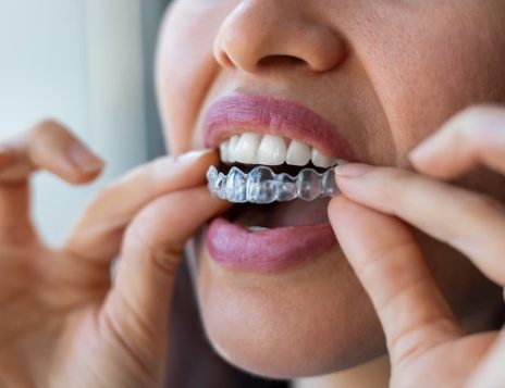 How to Avoid Common Invisalign Treatment Mistakes