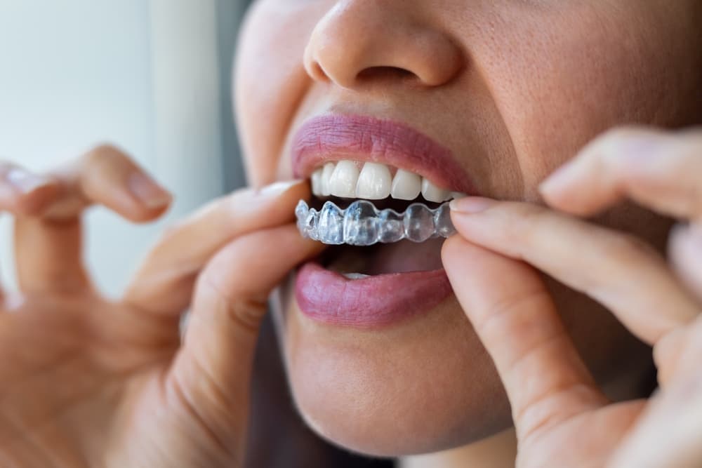 Common Invisalign Mistakes
