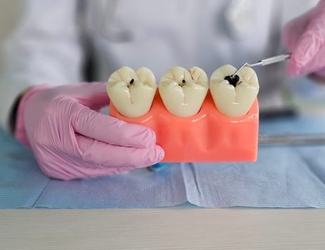 How Often Should Fissure Sealants Be Checked