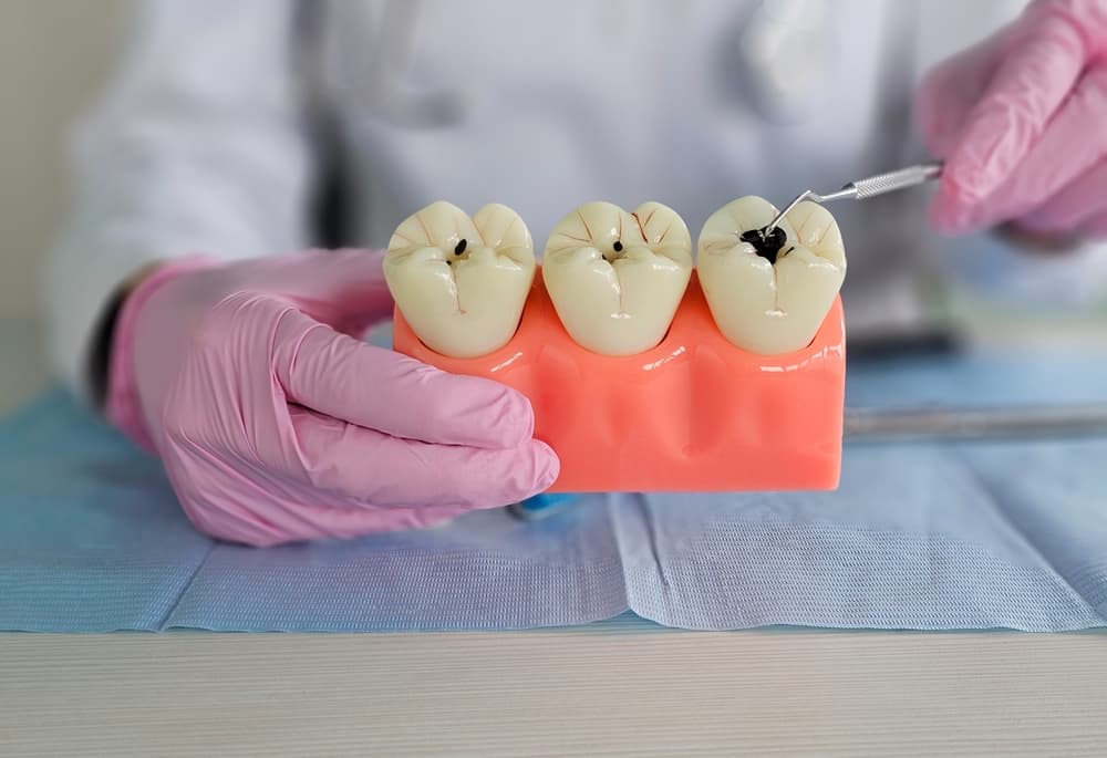 fissure sealant